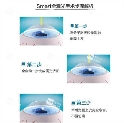 全激光smart手术步骤 全激光smart手术步骤