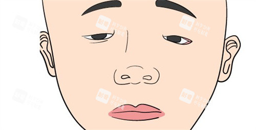 小睑裂综合征卡通图 小睑裂综合征卡通图