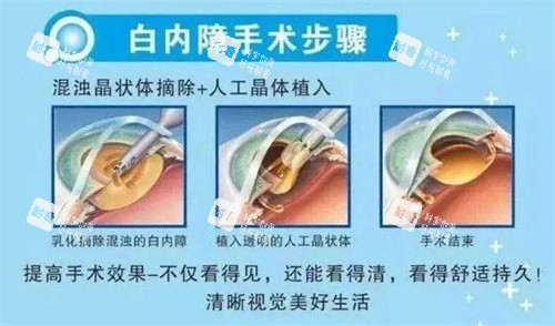 白内障手术示意图 白内障手术示意图