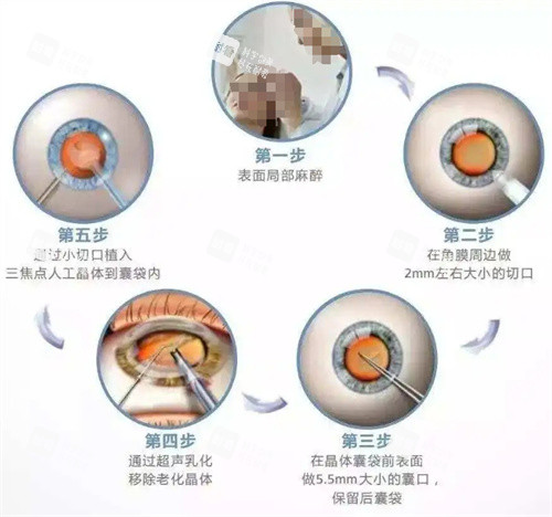 白内障超声乳化手术过程图 白内障超声乳化手术过程图