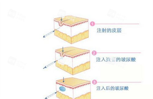 玻尿酸填充原理动画演示图 玻尿酸填充原理动画演示图