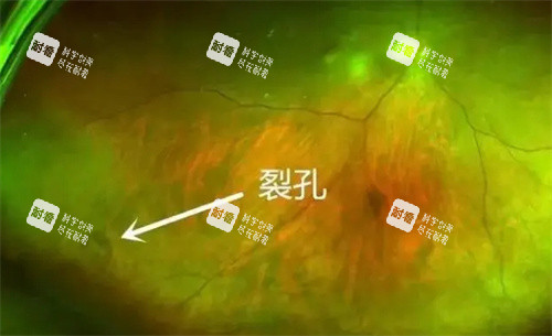 孔源性视网膜脱离裂孔部位 孔源性视网膜脱离裂孔部位