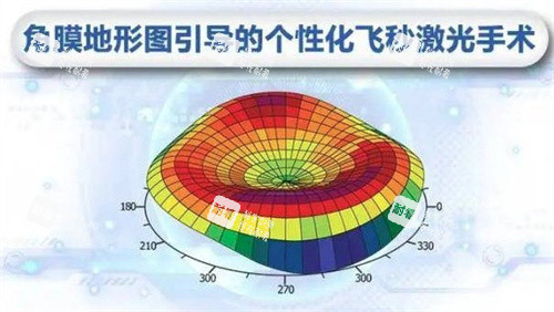 个性化飞秒激光手术