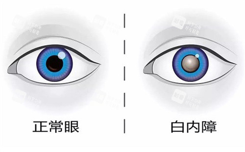 正常眼睛和白内障