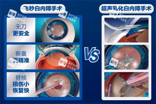 飞秒白内障手术过程