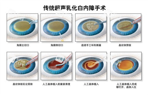超声乳化白内障手术