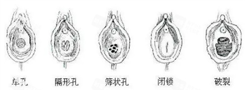 不同形状的处女膜 不同形状的处女膜