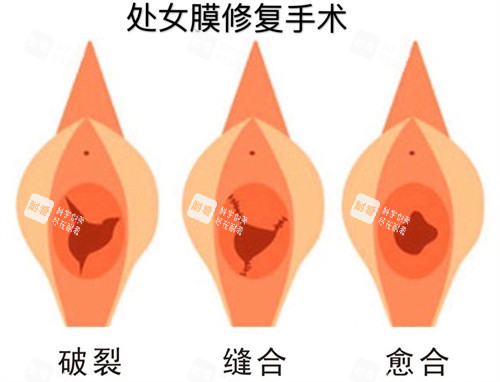 处女膜修复手术过程动画演示图 处女膜修复手术过程动画演示图