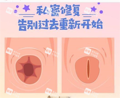 处女膜修复前后对比图 处女膜修复前后对比图