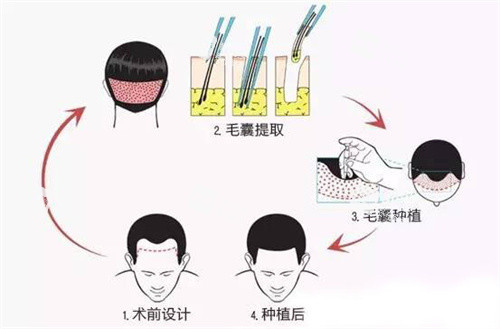 毛囊移植步骤动画图 毛囊移植步骤动画图