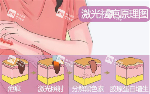 激光祛疤原理示图.jpg 激光祛疤原理示图.jpg