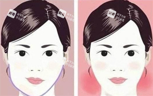 大小脸面部轮廓手术前后对比 大小脸面部轮廓手术前后对比