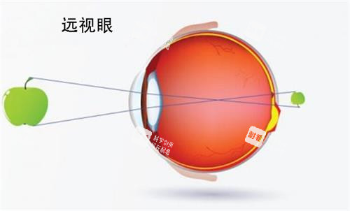 远视眼睛的视力 远视眼睛的视力