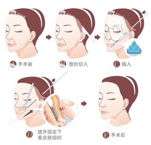 拉皮手术过程图.png 拉皮手术过程图.png