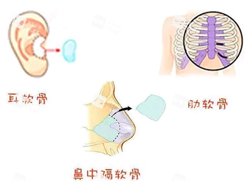 隆鼻手术.png