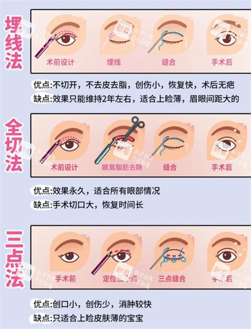 双眼皮三种手术方式动画.jpg 双眼皮三种手术方式动画.jpg