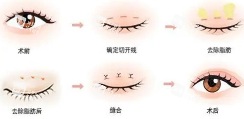 双眼皮手术过程图.JPG