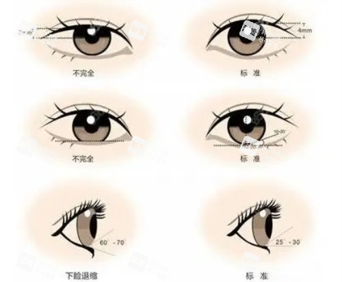 双眼皮对比图.JPG