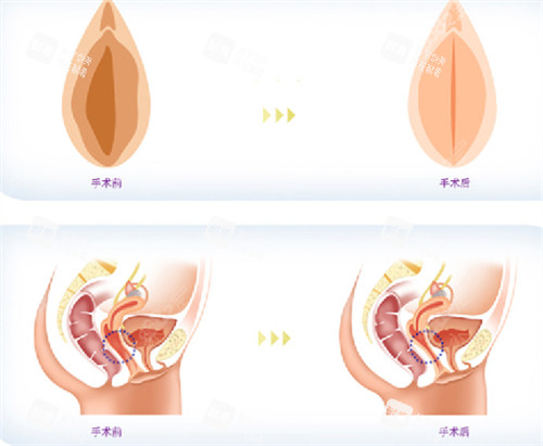 私密整形前后对比图 私密整形前后对比图