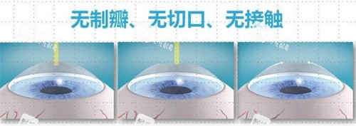 飞秒近视手术