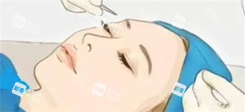 双眼皮手术过程卡通图