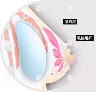 双平面丰胸