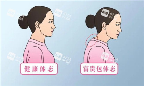 有无富贵包对比 有无富贵包对比