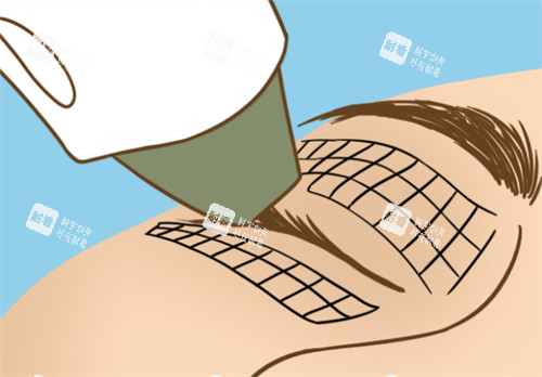 热玛吉眼部抗衰过程图解.jpg