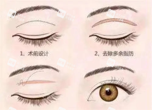 全切双眼皮卡通示意图.jpg