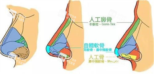 隆鼻手术对比