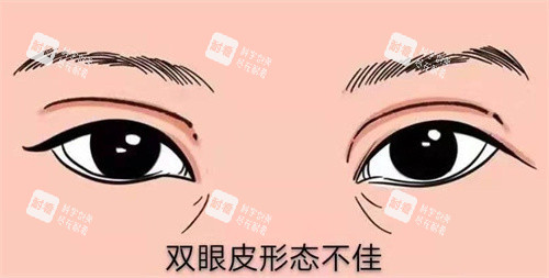 修复双眼皮 修复双眼皮