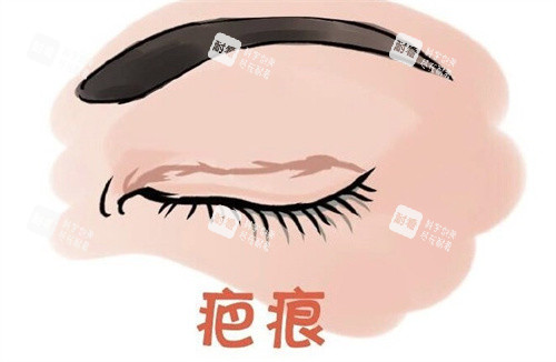 双眼皮术后疤痕 双眼皮术后疤痕