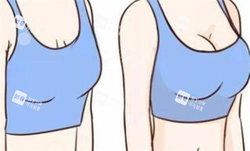 隆胸前后对比图 隆胸前后对比图