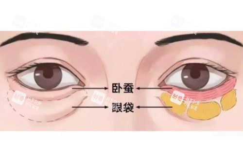 眼袋、卧蚕区分图