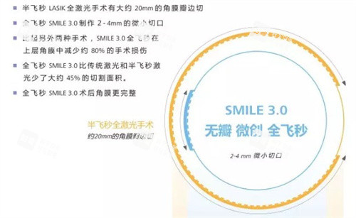 全飞秒手术3.0.jpg