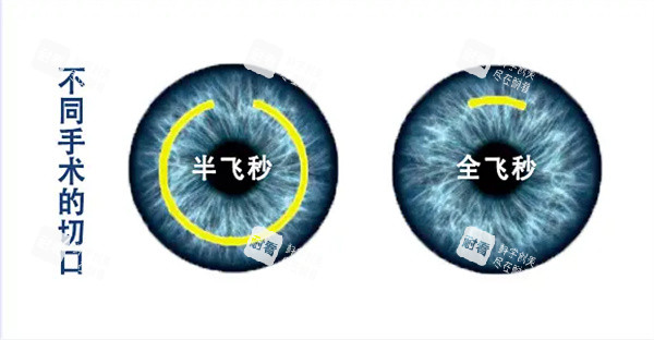 半飞秒和全飞秒区别.jpg 半飞秒和全飞秒区别.jpg