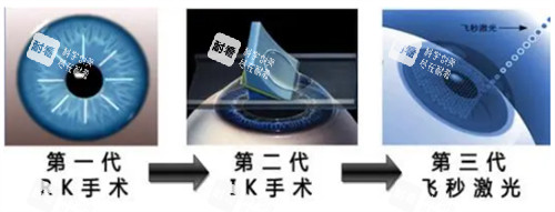 近视手术的进阶过程.jpg