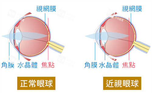 正常眼球和近视眼球的区别图解.jpg