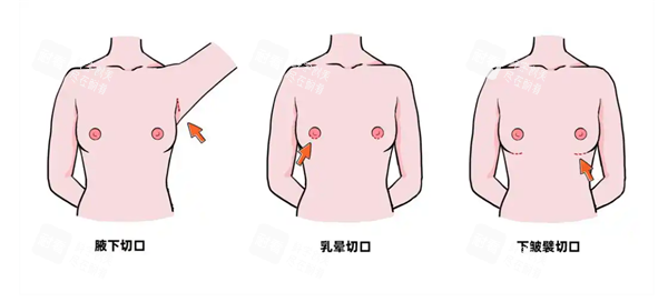 隆胸手术切口图.png