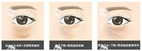 眼底脂肪重排对比 眼底脂肪重排对比
