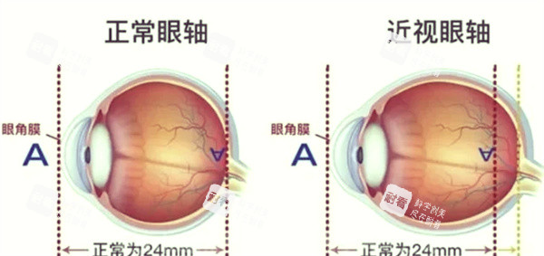 近视眼前后对比‘