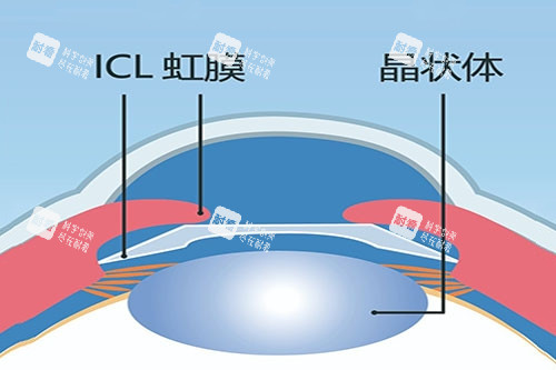 ICL晶体植入卡通图 ICL晶体植入卡通图