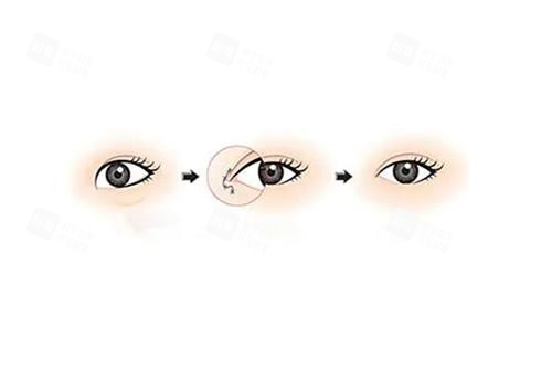 开眼角手术前后对比图 开眼角手术前后对比图