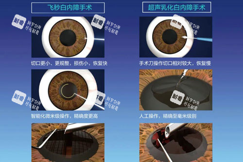 飞秒白内障和超声乳化白内障 飞秒白内障和超声乳化白内障