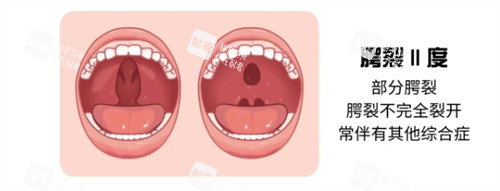 二度唇腭裂示意图 二度唇腭裂示意图