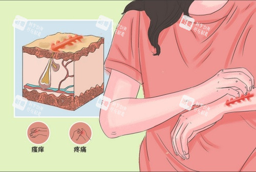 疤痕增生引起的症状示意图 疤痕增生引起的症状示意图