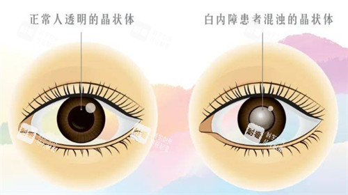 白内障和正常眼球的对比图