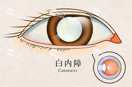 白内障卡通示意图 白内障卡通示意图