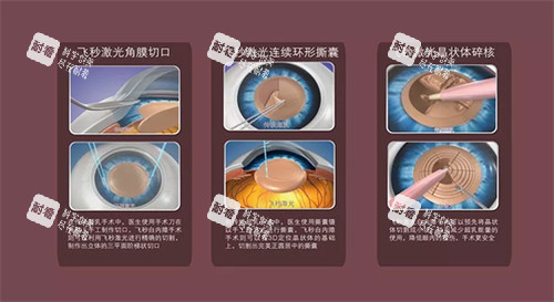 飞秒白内障手术流程 飞秒白内障手术流程