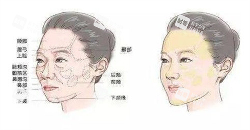 胶原蛋白面部填充前后 胶原蛋白面部填充前后
